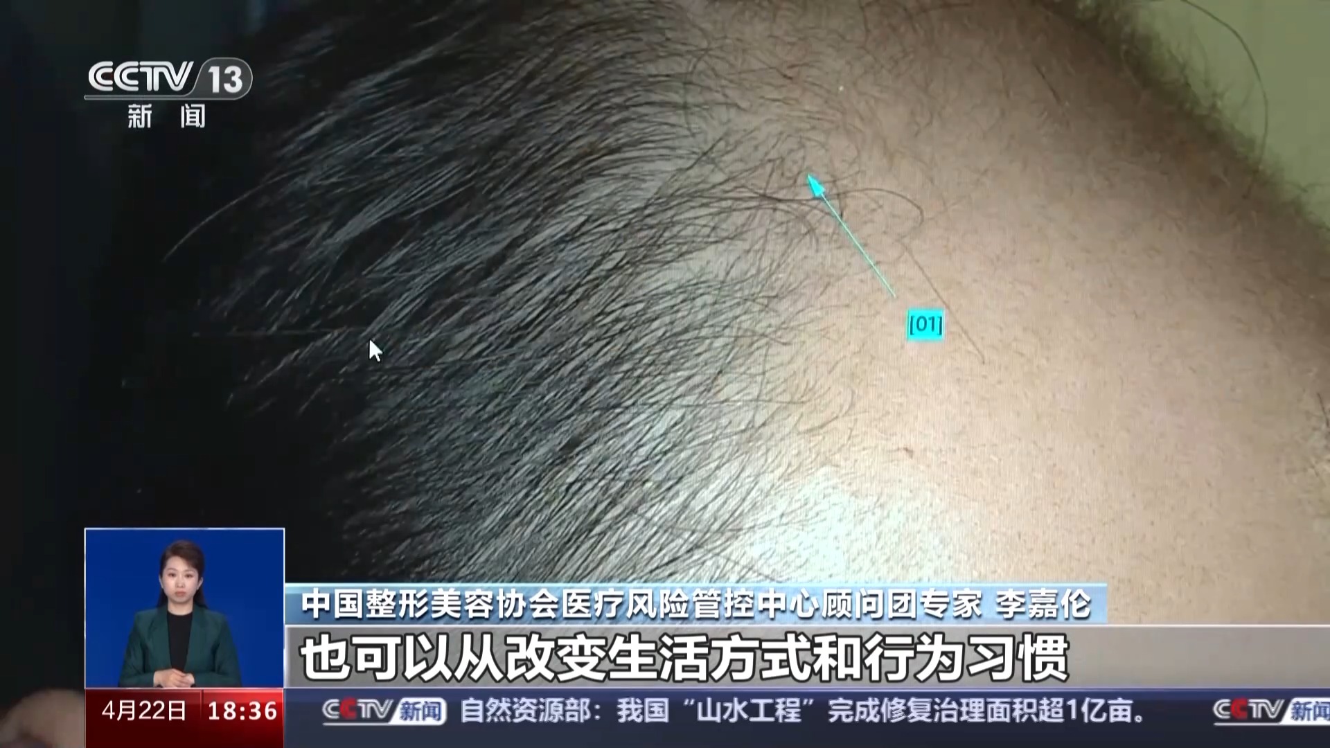 存活率成谜,维权难 央视曝光植发经济乱象