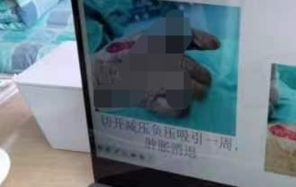 陕南一女子田里干活被蝮蛇咬伤 机智的她拔罐吸出毒液