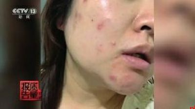 女子美容院祛痘竟越祛越多