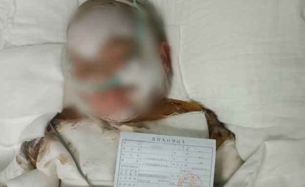 5岁男童跌入滚烫豆浆桶全身80%烧伤 医生坦言治疗难度大