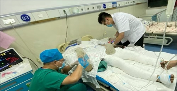 一个重度烧伤患者的重生之路