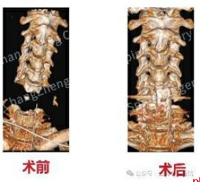 全球罕见！中国医生救回身首离断患者