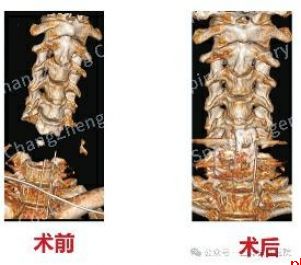 全球罕见！中国医生救回身首离断患者