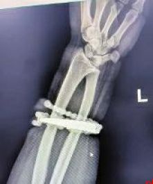 手镯10年没摘“长”进肉里 医生：再迟手臂就保不住了