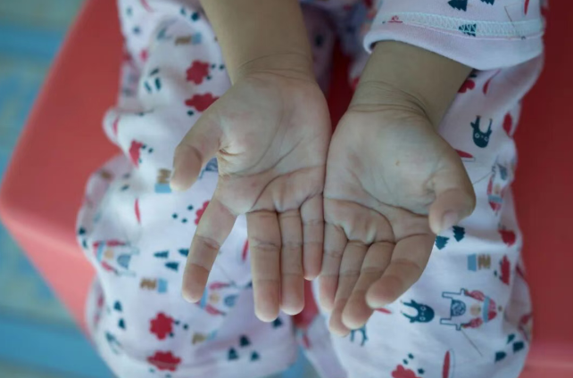 关于手足口病的8个常见误区 一次说清！