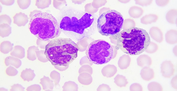 5分钟实现急性白血病精准诊断