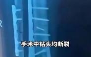 “手术钻头遗留患者体内” 官方通报