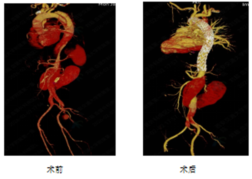 西安交大一附院血管外科成功完成复杂胸主动脉夹层合并马蹄肾介入手术
