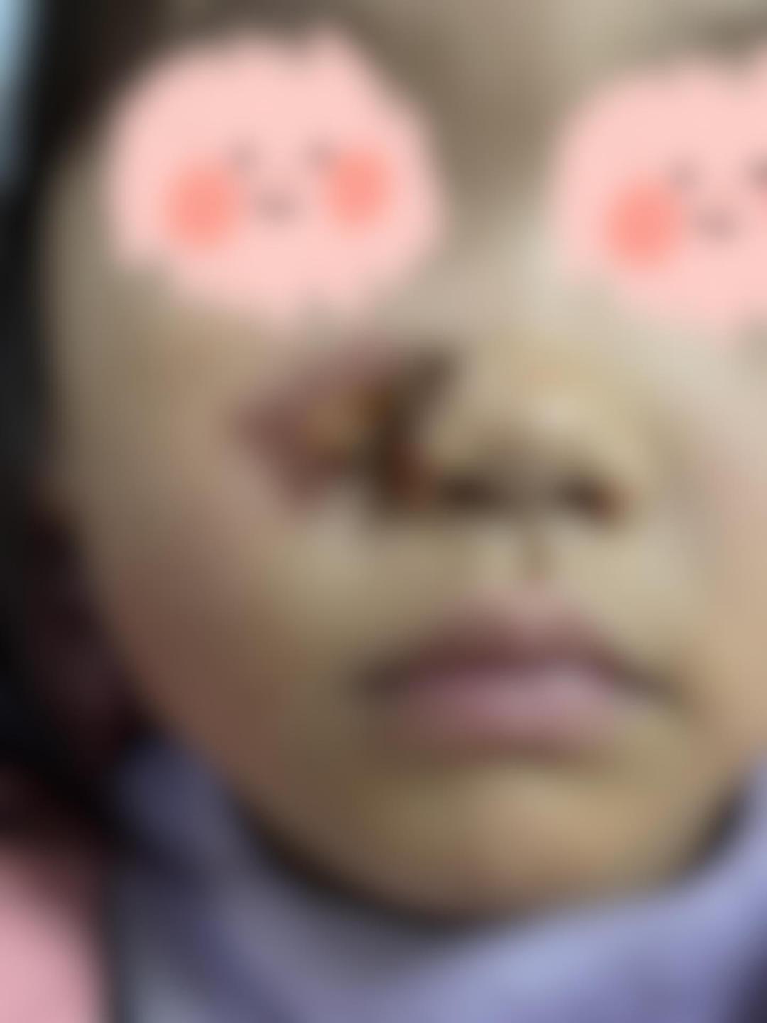 4岁女童看烟花时被鞭炮溅伤面部 医生：假期接诊近20例