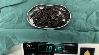 36岁男子胃中取出180颗铁钉：患有精神疾病存在异食行为