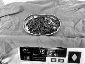 男子胃中取出181颗铁钉